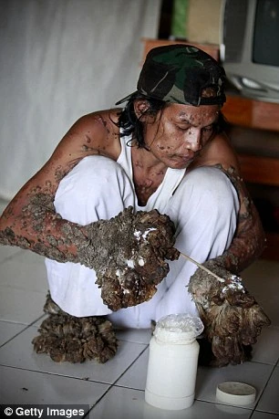 42 năm cuộc đời đầy bi kịch của người cây 42 năm cuộc đời đầy bi kịch của người cây