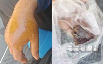 Bị rắn hổ mang chúa dài 2 mét cắn, người đàn ông chém đứt xác rắn&nbsp;rồi đến bệnh viện