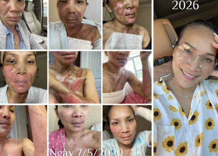 Ca sĩ đình đám của showbiz Việt một thời khoe nhan sắc rạng rỡ sau 6 năm bị bỏng nặng vì nồi xông hơi phát nổ Ca sĩ đình đám của showbiz Việt một thời khoe nhan sắc rạng rỡ sau 6 năm bị bỏng nặng vì nồi xông hơi phát nổ