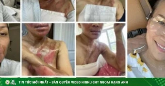 Ca sĩ đình đám của showbiz Việt một thời khoe nhan sắc rạng rỡ sau 6 năm bị bỏng nặng vì nồi xông hơi phát nổ