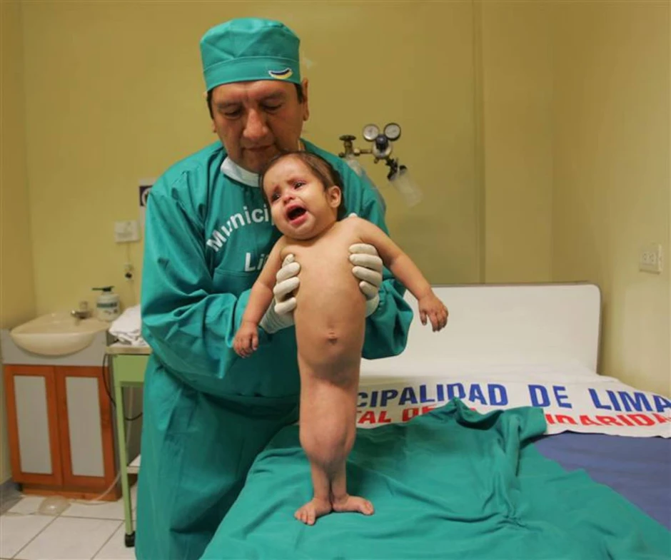 Nàng tiên cá ngoài đời thực: Bé gái chào đời với đôi chân dính liền và 15 năm sống năm phi thường như "một kỳ tích y học"