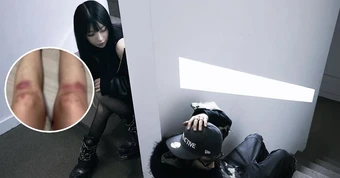 Nữ ca sĩ yêu lại bạn trai cũ từng đánh cô bầm dập toàn thân: “Tôi không kiện anh ấy nữa”