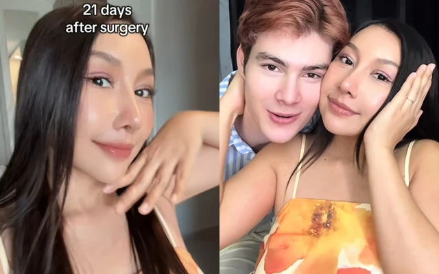 Gương mặt sau 21 ngày phẫu thuật thẩm mỹ của cô vợ cao 1m55 áp lực vì chồng Tây quá đẹp trai, cao gần 2m