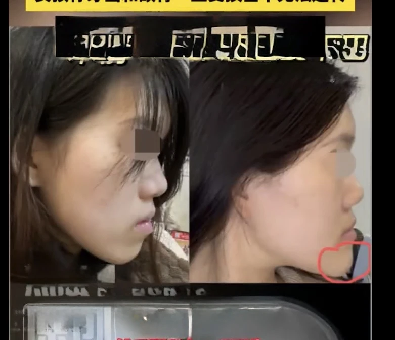 Cô gái bị biến dạng khuôn mặt sau PTTM, bi kịch đau khổ vì quyết định sai lầm