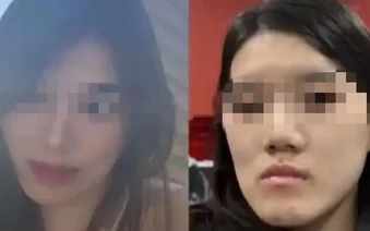 Cô gái bị biến dạng khuôn mặt sau PTTM, bi kịch đau khổ vì quyết định sai lầm